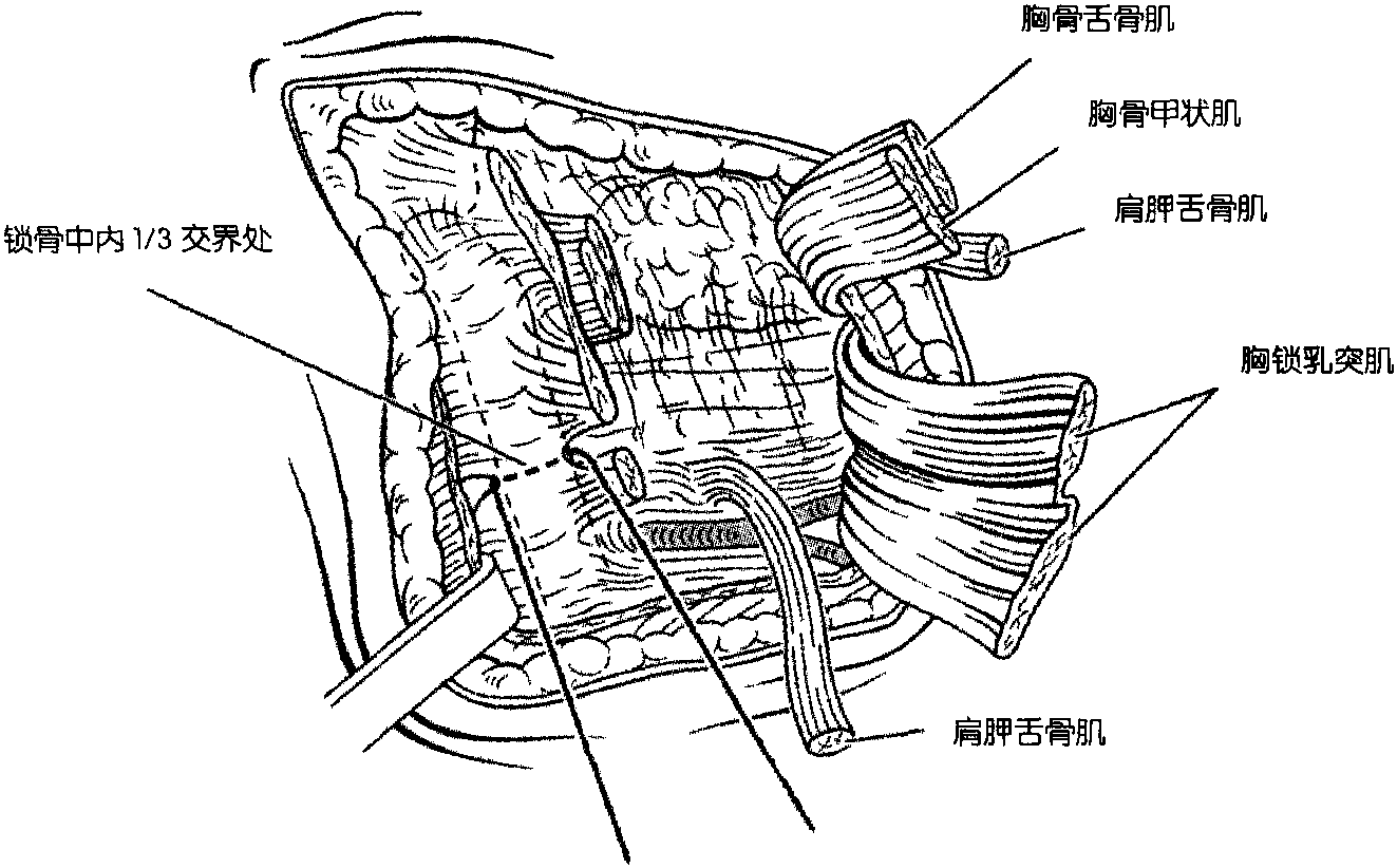 三、改良的前方手術(shù)入路